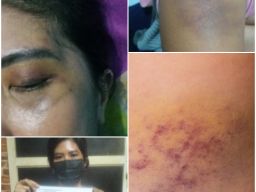 Perempuan di Genteng Surabaya Babak Belur Dianiaya Pacar