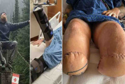 Sepelekan Luka Bakar Kecil, Kedua Max Armstrong Diamputasi