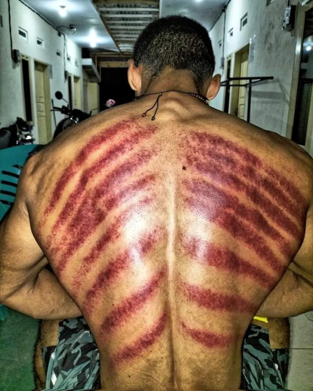 Kerokan diyakini menyembuhkan masuk angin